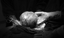 Cắt khối u "khủng" 1,6kg trong dây chằng rộng của một phụ nữ
