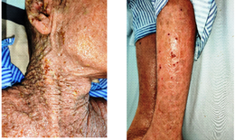 Người suy giảm miễn dịch dễ nhiễm vi rút Herpes gây bệnh da