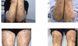 Hà Nội: Người phụ nữ mắc phong thể nhiều vi khuẩn giống Lupus ban đỏ