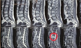 Điều trị hiệu quả xẹp đốt sống bằng phương pháp hiện đại