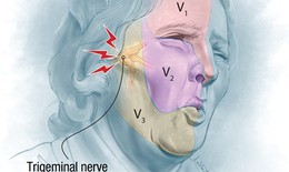 Đau dây thần kinh số V - Cơn đau dữ dội như "chết đi sống lại"