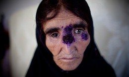 Nóng: Bệnh Leishmaniasis “ăn thịt người” càn quét Trung Đông