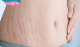 Chữa trị rạn da sau sinh thế nào cho đúng