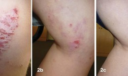 Điều trị viêm da dị ứng ở trẻ em bằng phương pháp Dr Michaels thảo dược