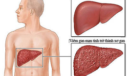 Bệnh xơ gan bắt nguồn từ đâu?