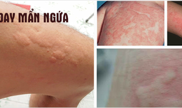 Mề đay, lupus ban đỏ không còn là nỗi lo