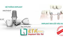ETK Active - Giải pháp trồng răng giả cho người bận rộn