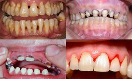 Bọc răng sứ gi&#225; rẻ dễ g&#226;y biến chứng nguy hiểm