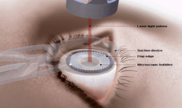 Điều cần biết khi phẫu thuật mắt bằng phương pháp LASIK