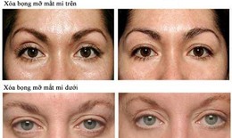 Làm gì để có đôi mắt đẹp hơn?