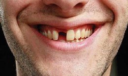 Bị mất răng cửa th&#236; n&#234;n trồng răng bằng phương ph&#225;p n&#224;o th&#237;ch hợp?