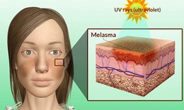 Muốn trị nám hiệu quả đừng bỏ qua mùa đông