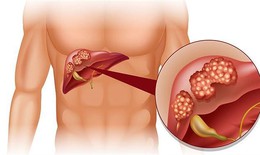 LEM - thành phần mà người ung thư gan, viêm gan mạn tính, xơ gan nên biết