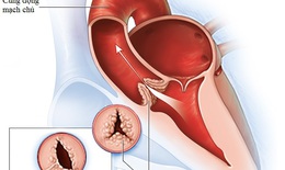 Hở van động mạch chủ, những th&#244;ng tin quan trọng cần nắm r&#245;