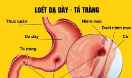 Những thói quen tốt dành cho người bị viêm loét dạ dày, tá tràng