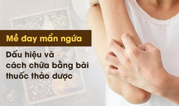 Nổi mề đay mẩn ngứa: Dấu hiệu và cách chữa bệnh bằng bài thuốc thảo dược