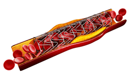 Đặt stent mạch vành kéo dài 10-15 năm là hoàn toàn có thể nếu biết cách chăm sóc