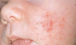 Một số bệnh ngoài da do virus thường gặp – Giải pháp ưu việt từ sản phẩm thảo dược thiên nhiên