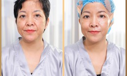 Chăm sóc da sau khi sử dụng phương pháp trẻ hoá da Collagen Smart Fiber