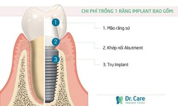 Giá trồng răng Implant hiện nay như thế nào là hợp lý nhất?
