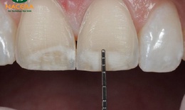 Bạn c&#243; đang “hiểu lầm” về phủ răng sứ?
