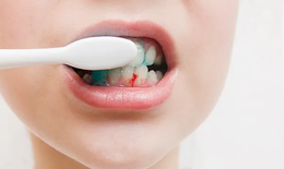 Chảy máu chân răng khi đánh răng – không thể chủ quan