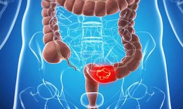 Phát hiện ung thư đại trực tràng sớm, có cơ hội chữa khỏi bệnh đến 90%