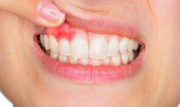 “Thủ phạm” gây viêm lợi, viêm nướu răng và cách khắc phục hiệu quả
