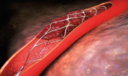 Khi nào cần đặt stent mạch vành, đặt rồi có khỏi bệnh không?