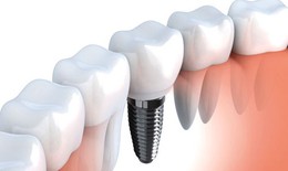 Cấy ghép Implant - 3 yếu tố chính quyết định 1 ca cấy ghép implant thành công
