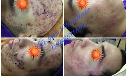 Điều trị mụn, giảm tối đa sẹo trên da