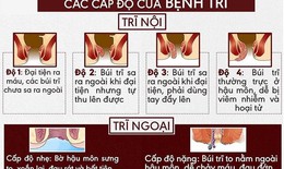 Những dấu hiệu nhận biết điển hình của bệnh trĩ