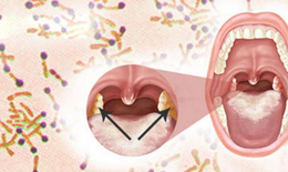 Phòng ngừa nguy cơ mắc bệnh bạch hầu cho học sinh