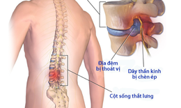 Hậu quả và các biến chứng của bệnh thoái hóa cột sống lưng và cột sống cổ