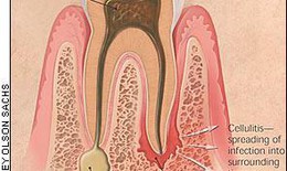 Viêm mô tế bào lan tỏa vùng hàm mặt –  Biến chứng bệnh lý răng miệng
