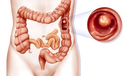 Bí kíp giúp người viêm đại tràng tự do ăn uống không lo tái lại