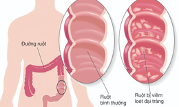 Viêm đại tràng mạn tính: triệu chứng, nguyên nhân, phòng và điều trị bệnh