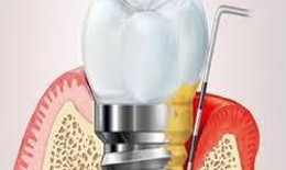 Vi&#234;m quanh Implant: C&#225;ch ph&#242;ng ngừa v&#224; điều trị