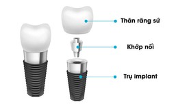 Trồng răng implant - Phương ph&#225;p &quot;đột ph&#225;&quot; trong phục h&#236;nh răng đ&#227; mất hiện nay