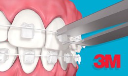 Ứng dụng công nghệ vào niềng răng thẩm mỹ