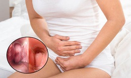 Không cần diệt tuyến nếu khắc phục đúng cách viêm lộ tuyến diện rộng
