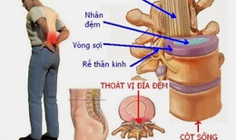Thoát vị đĩa đệm là gì? Triệu chứng, nguyên nhân, cách khắc phục