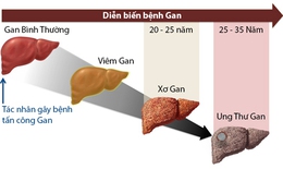 Những điều cần biết để có lá gan khỏe mạnh