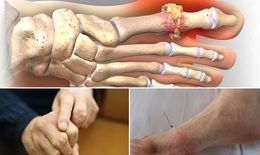 Bệnh gout trẻ hóa, hậu quả khôn lường nếu không xử lý kịp thời