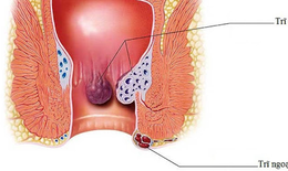 Chuyên gia "mách" bạn cách điều trị trĩ cấp đúng, hiệu quả nhanh