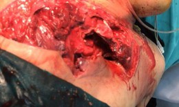 Hy hữu: Bệnh nhân bị tai nạn giao thông lộ tim và phổi ra ngoài thành ngực