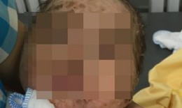 Cảnh báo: Mẹ tắm thuốc nam khiến bé 4 tháng mắc thuỷ đậu bị nhiễm độc da