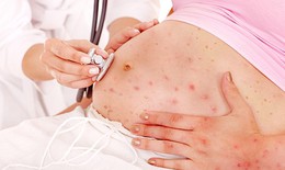 Bà bầu đề phòng biến chứng do thủy đậu