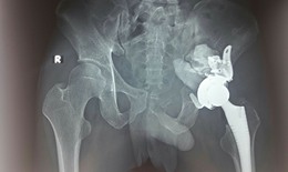 Đau khớp háng không rõ nguyên nhân, nam bệnh nhân bị u ổ cối xương chậu hiếm gặp