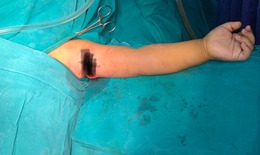 Cảnh báo: Trẻ bị tổn thương cánh tay nghiêm trọng do đụng vào mảnh vỡ khi vừa cầm cốc thuỷ tinh vừa chạy